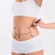 Chirurgie esthétique abdominoplastie Tunisie prix