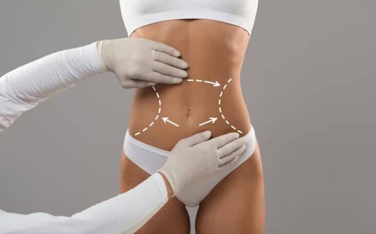 Chirurgie esthétique abdominoplastie circulaire Tunisie tout compris