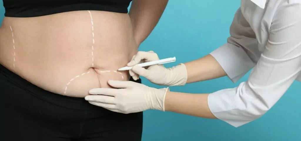 Combien de temps faut-il pour qu’une incision d’abdominoplastie guérisse ?