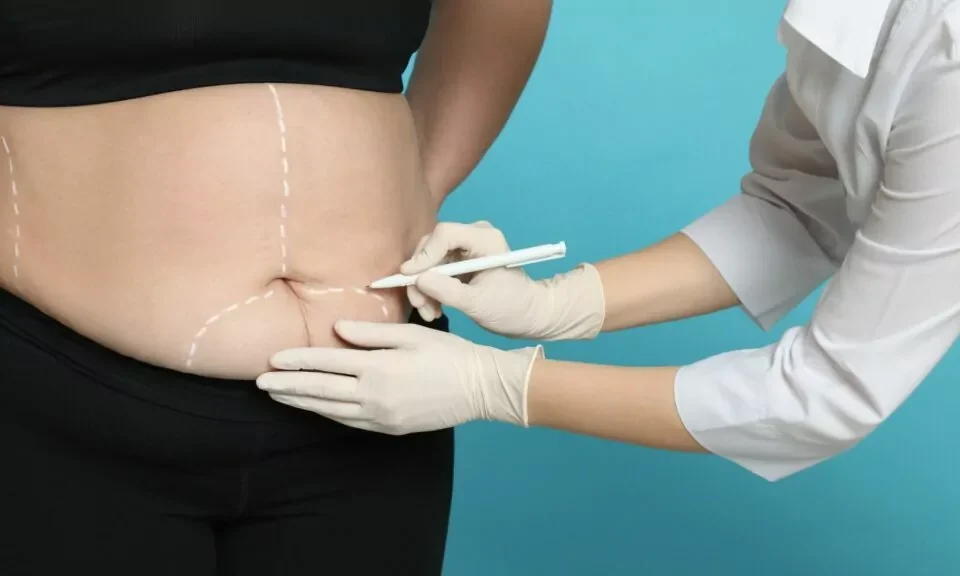 Combien de temps faut-il pour qu’une incision d’abdominoplastie guérisse ?