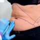 Puis-je subir une abdominoplastie à 50 ans ?