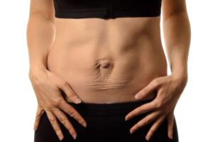 Comment enlever une diastasis abdominale ?