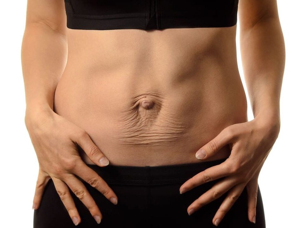 Comment enlever une diastasis abdominale ?