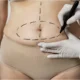 Combien de temps dure une abdominoplastie 360° ?