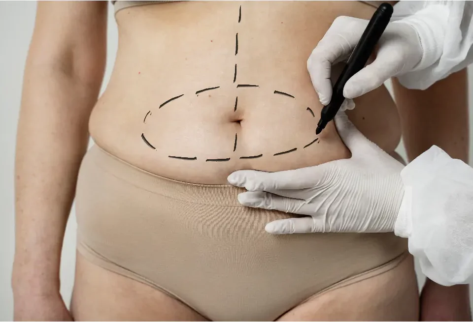 Combien de temps dure une abdominoplastie 360° ?