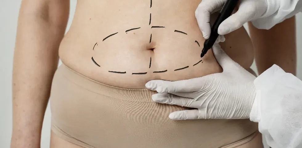 Combien de temps dure une abdominoplastie 360° ?